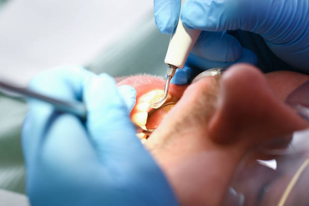 Best Emergency Dentist for Lost Fillings or Crowns in Lus Valley Marinwood, CA